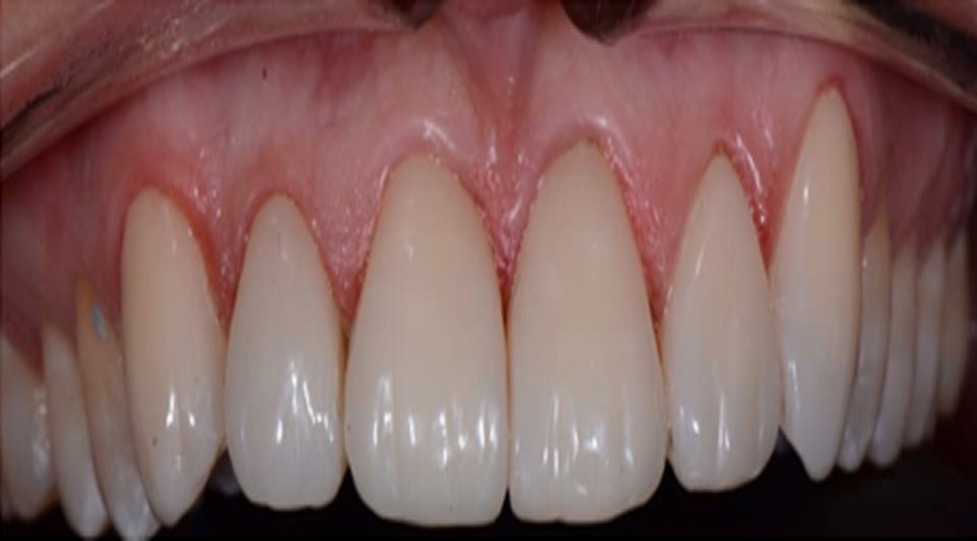 بعد تجميل الاسنان والحشوات التجميل 6